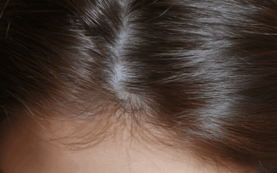 ¿Funcionan las Ampollas con Células Madre para la Caída del Cabello? Mitos y Realidades